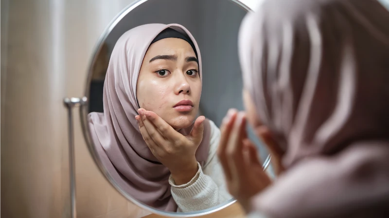Bedanya Jerawat Hormonal dan Jerawat Karena Skincare yang Tidak Cocok